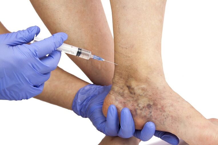 injections for varicose veins