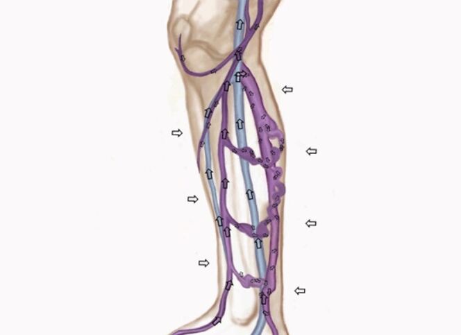 changes in the direction of blood movement with varicose veins