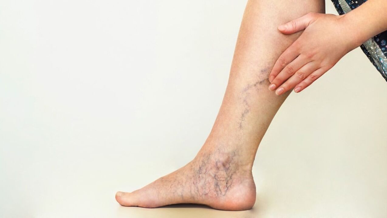 significant varicose veins on the legs